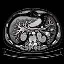МРТ підшлункової залози