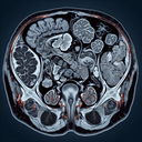 МРТ малого тазу у жінок