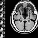 МРТ черепно-мозкових нервів